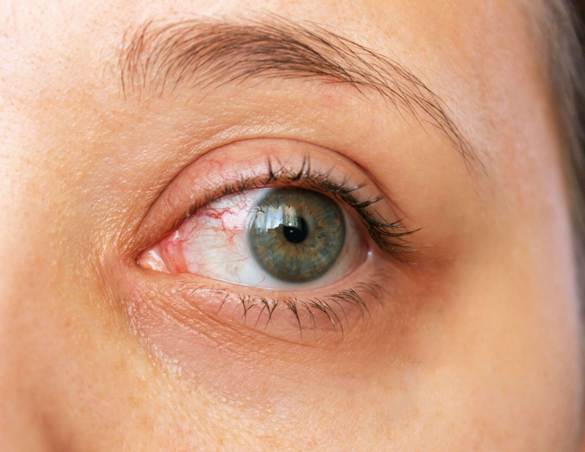 Foto de una mujer con ojos secos.